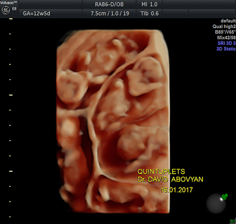 3D/4D Ultrasound/Doppler