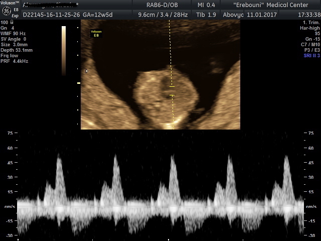 Tricuspid flow