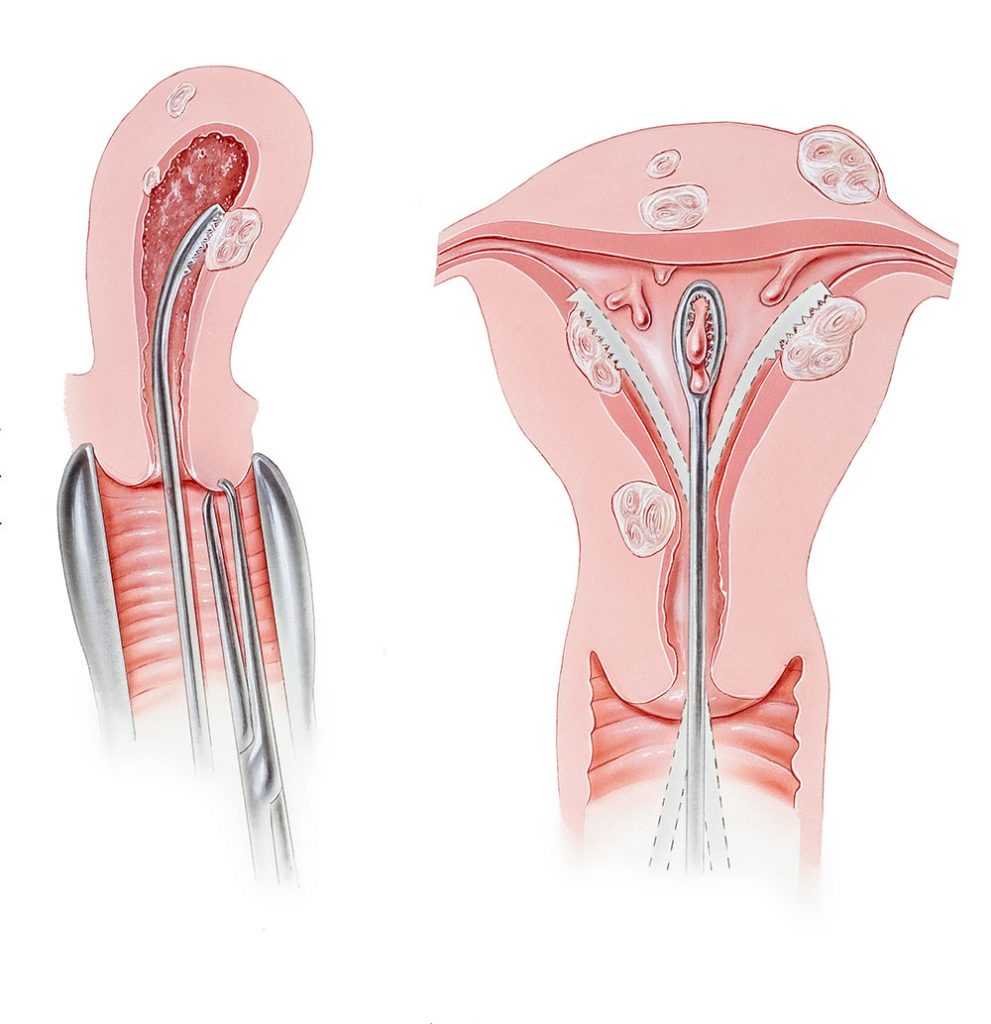 D&C Dilatation curettage pathology